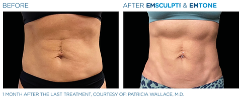 Before and after photos of a woman's abdomen showing more fat and less muscle tone before and tighter, more sculpted abs after Emsculpt NEO treatment.