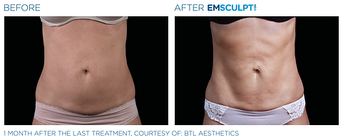 Before and after photos showing the front of a woman's abdomen with less muscle tone before and firmer, more sculpted muscles after Emsculpt NEO body contouring treatment.