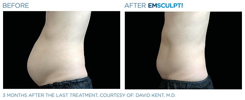 Before and after photos showing a man's abdomen with excess fat and no muscle tone before and a flatter, leaner, more muscular abdomen after Emsculpt NEO treatment.