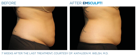 Before and after photos showing a woman's abdomen with excess fat and little muscle tone before and a firmer, more sculpted abdomen after Emsculpt NEO body contouring treatment.