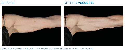 Before and after photos showing a woman's upper arm with less muscle tone and more fat before and leaner, firmer muscles after Emsculpt NEO treatment.