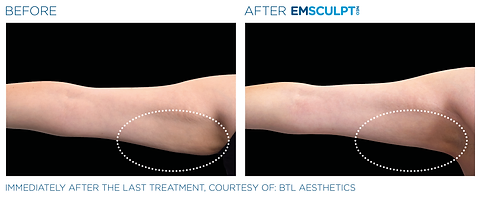 Before and after photos showing a woman's arm with excessive fat and very little muscle before and a tighter, firmer, more muscular arm after Emsculpt NEO treatment at Coastal Carolina Aesthetics.