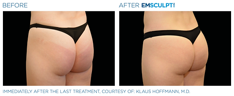 Before and after photos showing a woman's flat, sagging buttocks before and a tighter, firmer, more lifted buttocks after Emsculpt NEO treatment.
