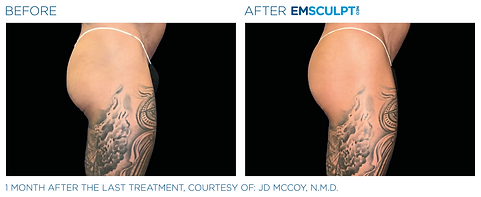 Before and after photos showing the side profile of a woman's buttocks. Her buttocks is flatter and less toned before and more lifted and toned after Emsculpt NEO treatment.