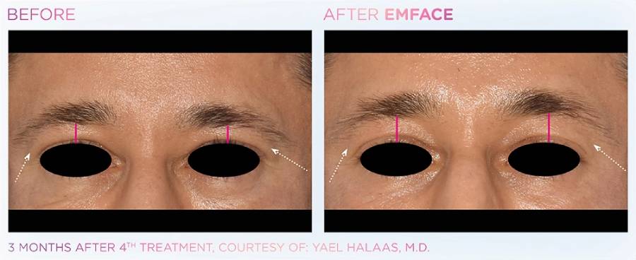Before and after photos showing a man's eyes with sagging brows before and a tighter, more lifted brow after Emface treatment.
