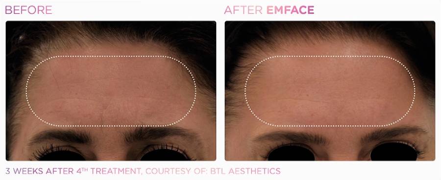 Before and after photos of a woman's forehead showing fine lines and wrinkles before and fewer lines and wrinkles and tighter skin after Emface treatment.