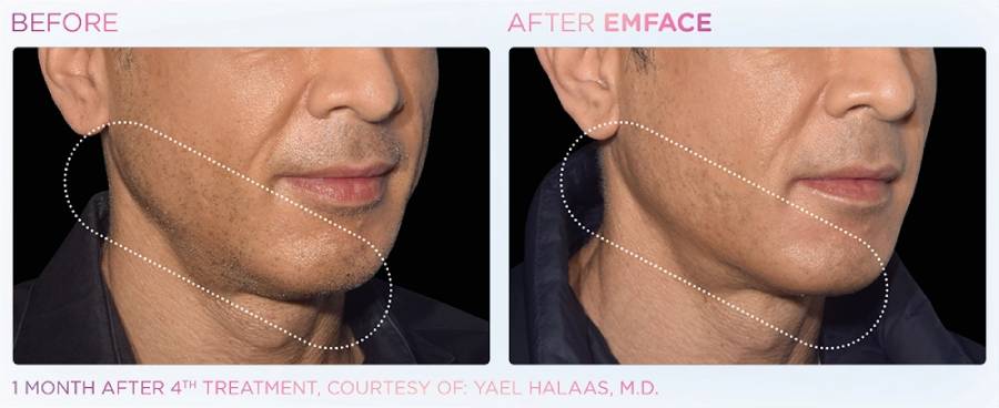 Before and after photos showing a man's jawline with sagging skin before and a more lifted, contoured appearance after Emface instant facelift treatment.
