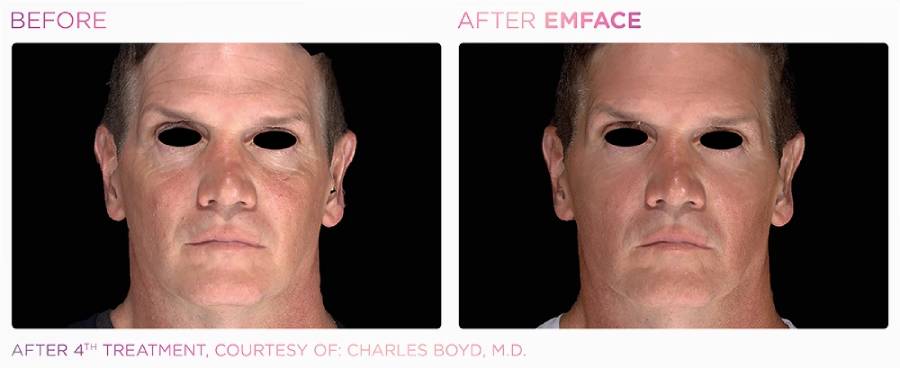 Before and after photos showing a man's face with sagging skin, fine lines, and wrinkles before and firmer, tighter, smoother skin after Emface treatment.