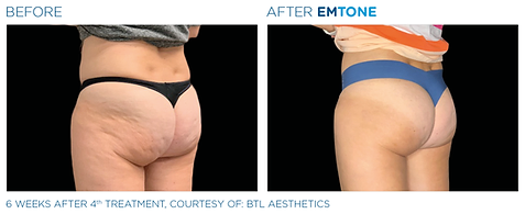 Before and after photos showing a woman's buttocks with dimpled, uneven skin before and smoother, less dimpled skin after Emtone cellulite reduction treatment.