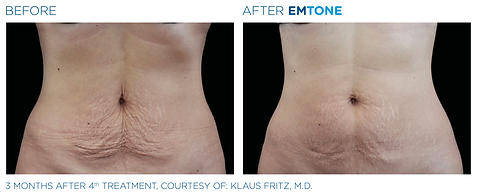 Before and after photos of a woman's abdomen showing loose skin with cellulite before and smoother, firmer skin after Emtone cellulite reduction treatment.