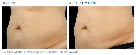 Before and after photos showing a woman's abdomen with loose, dimpled skin before and firmer skin with less cellulite after Emtone treatment.