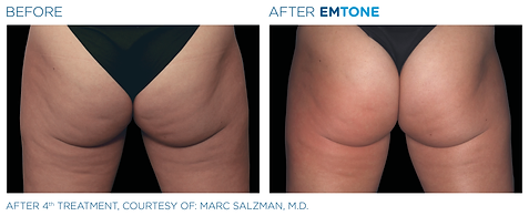 Before and after photos showing a woman's buttocks with dimpled, uneven skin before and smoother, tighter skin after Emtone treatment.