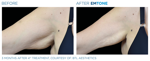 Before and after photos showing a woman's upper arm with sagging, dimpled skin before and firmer, less dimpled skin after Emtone cellulite reduction treatment.