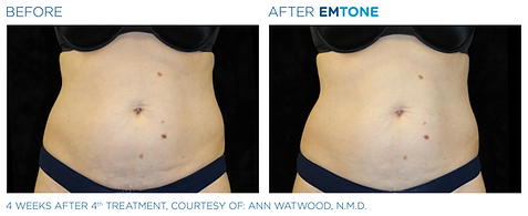 Before and after photos showing a woman's abdomen with loose skin with cellulite before and smoother, firmer skin after Emtone cellulite reduction treatment.