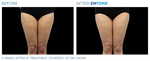 Before and after photos showing a woman's thighs with dimpled, uneven skin before and smoother, more even textured skin after Emtone cellulite reduction treatment.